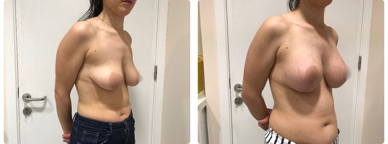 Resultados en mastopexia