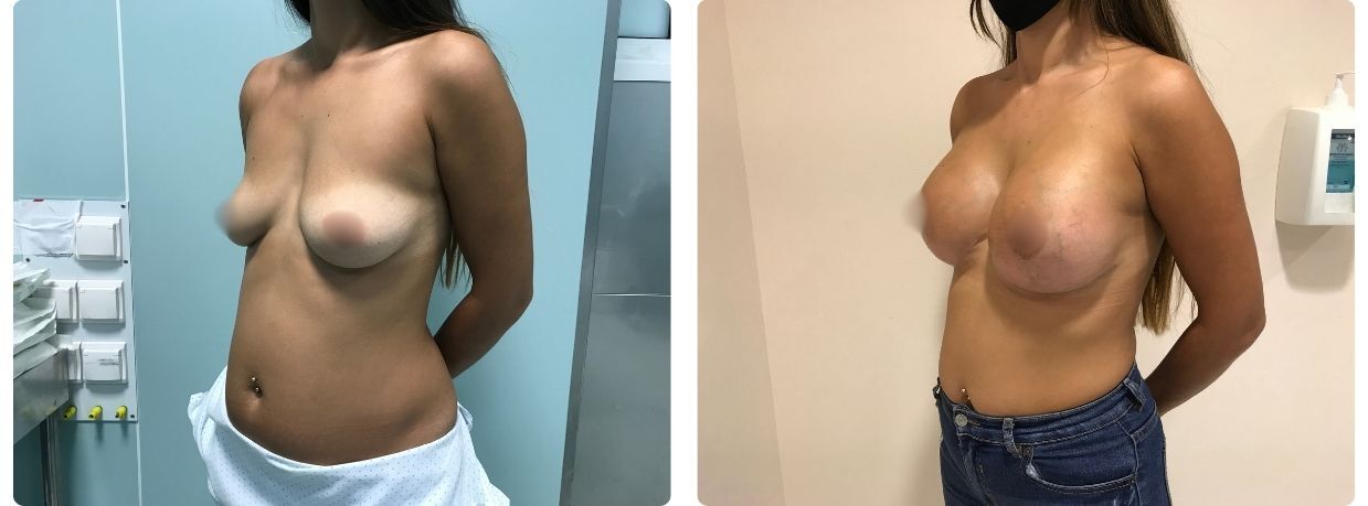 Resultados en mastopexia