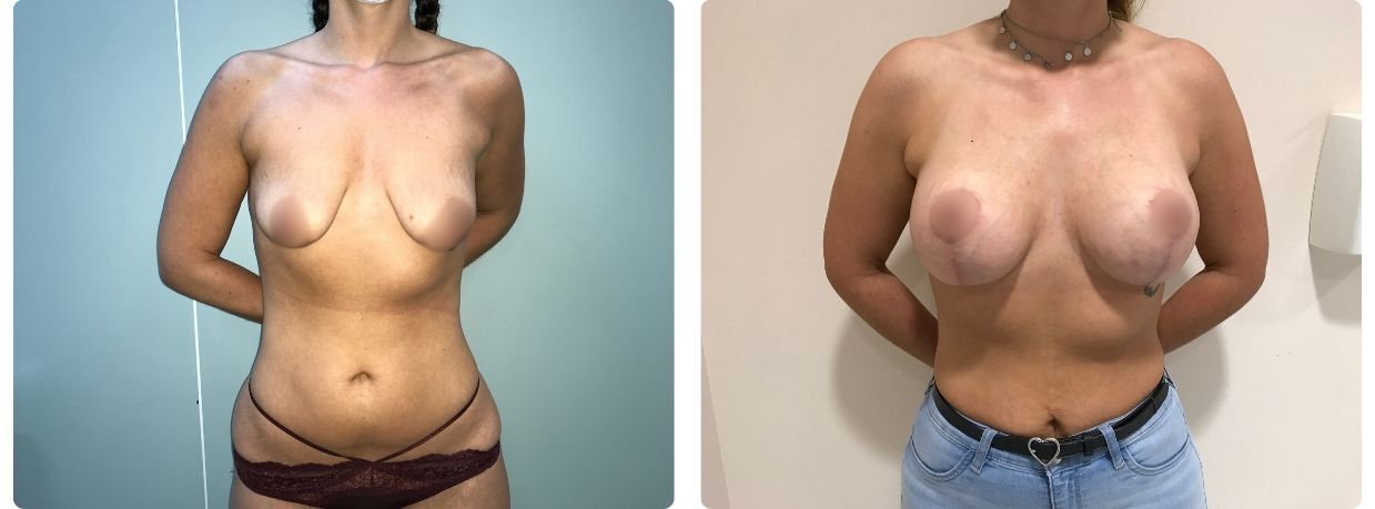 Resultados en mastopexia