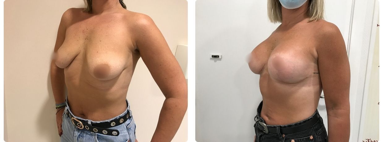 Resultados en mastopexia