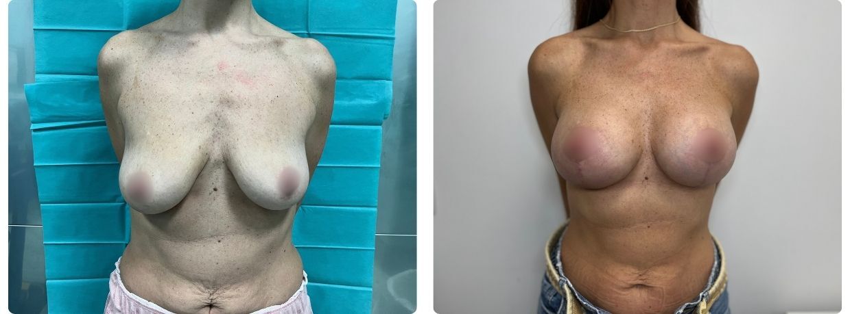 Resultados en mastopexia