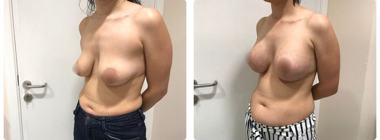 Resultados en mastopexia implantes