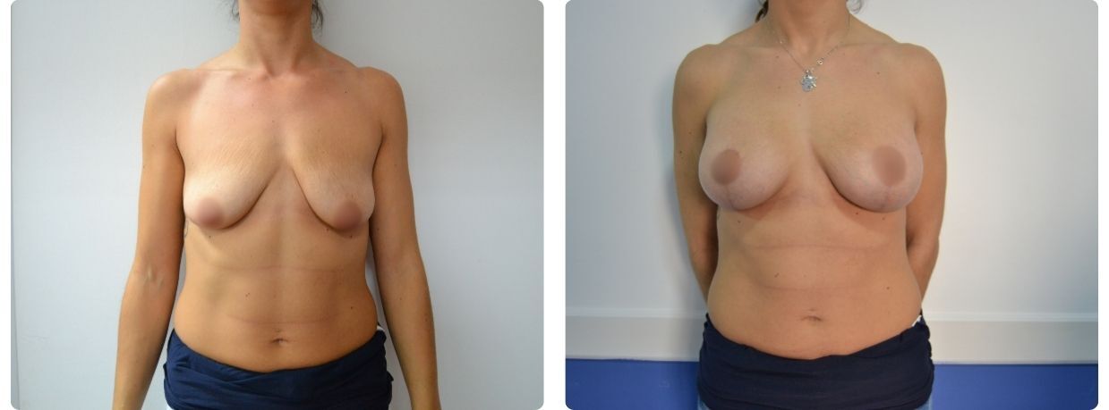Resultados en mastopexia implantes