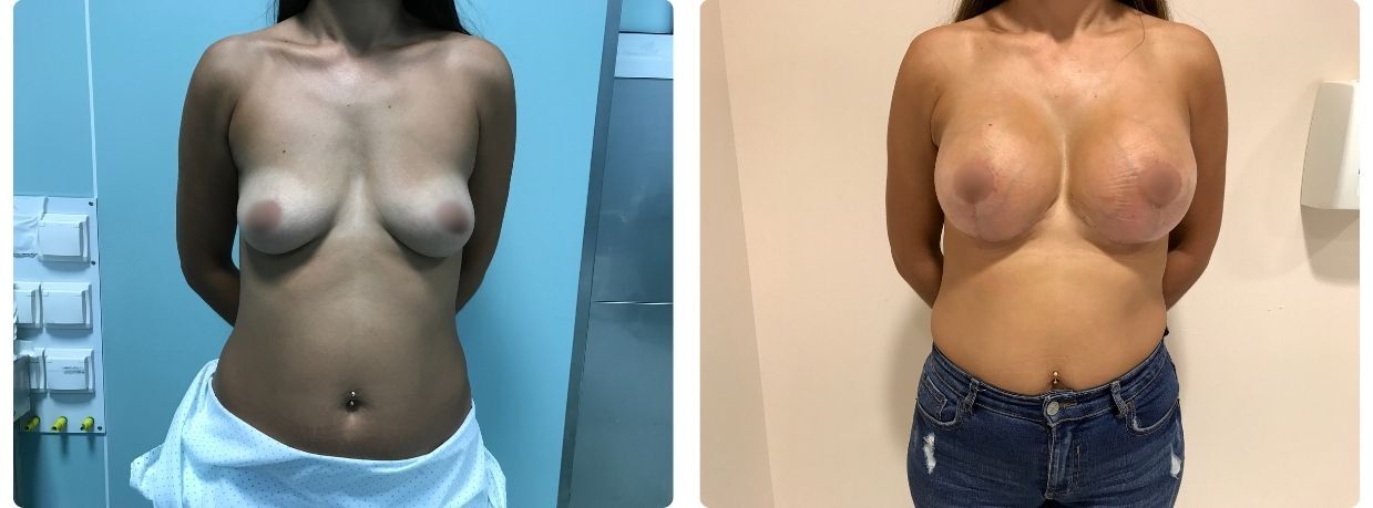 Resultados en mastopexia implantes