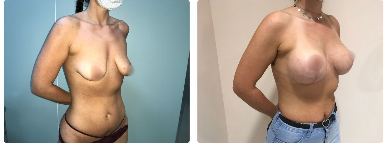 Resultados en mastopexia implantes