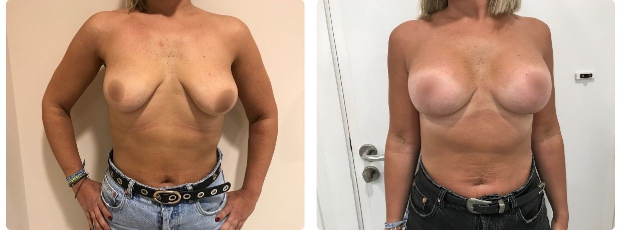Resultados en mastopexia implantes