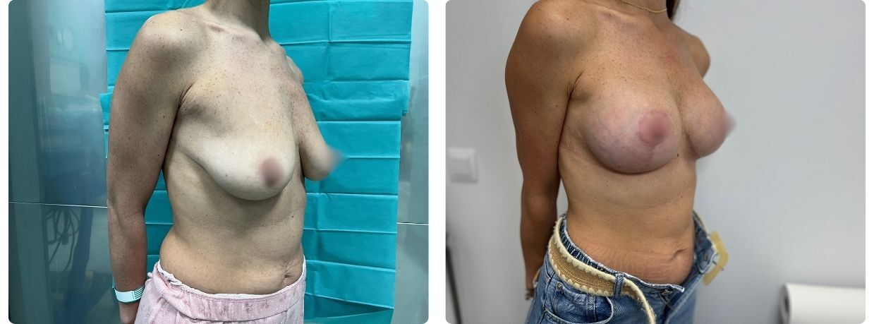Resultados en mastopexia implantes