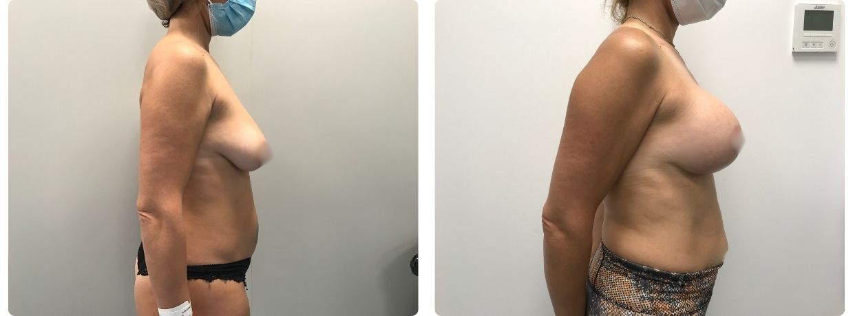 Resultados en mastopexia implantes