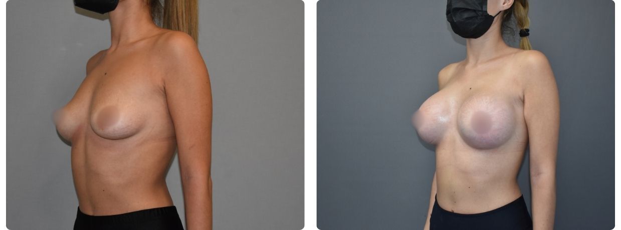 Resultados en mastopexia implantes