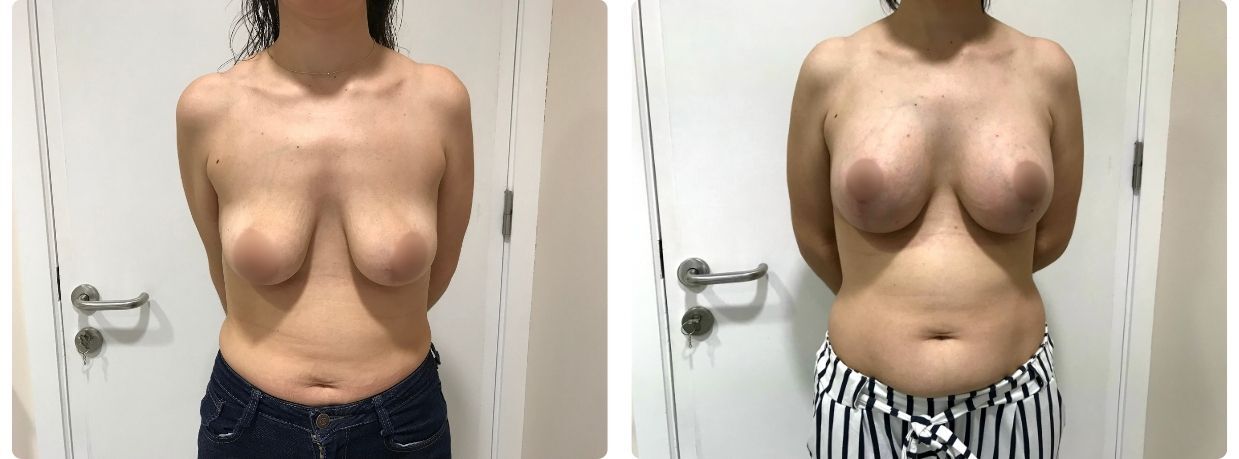 Resultados mastopexia con implantes
