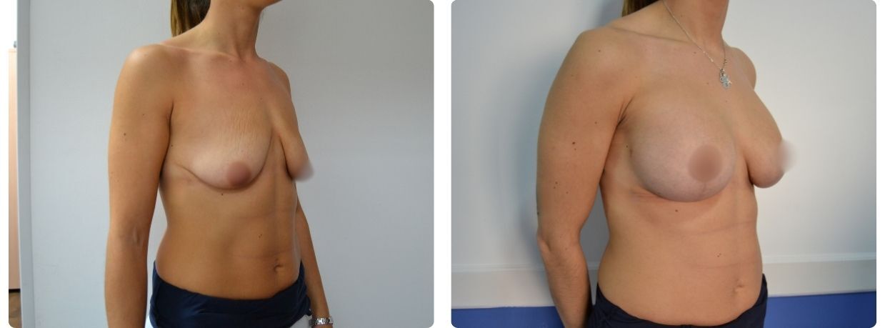 Resultados mastopexia con implantes