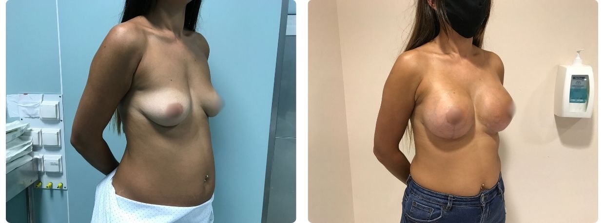 Resultados mastopexia con implantes