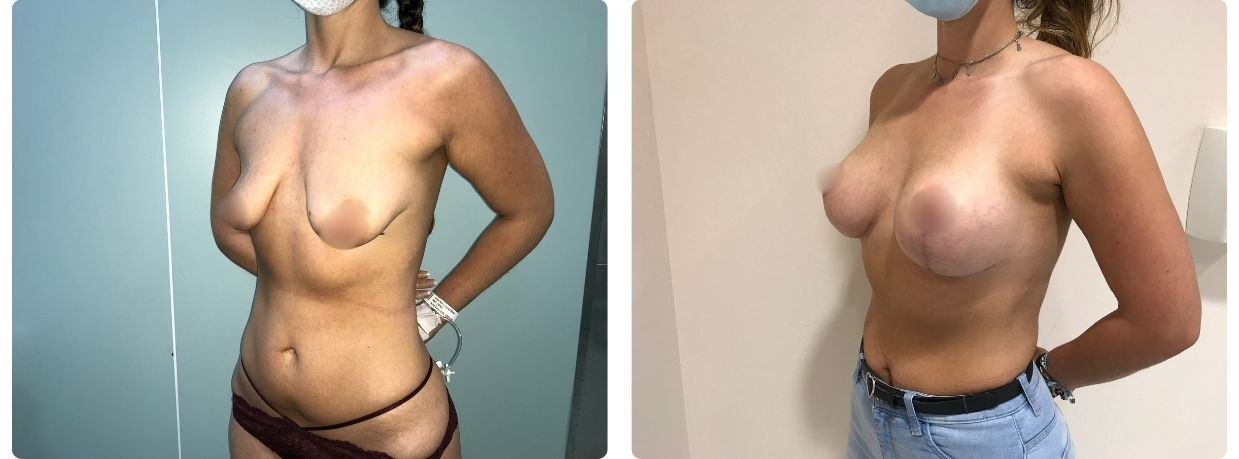 Resultados mastopexia con implantes