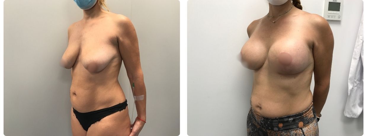 Resultados mastopexia con implantes