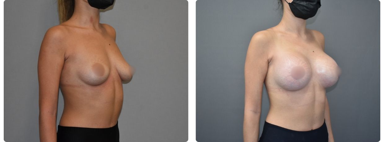 Resultados mastopexia con implantes