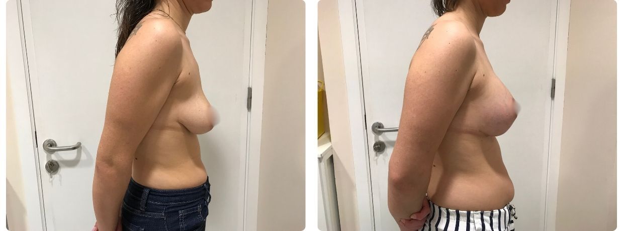 Resultados mastopexia implantes