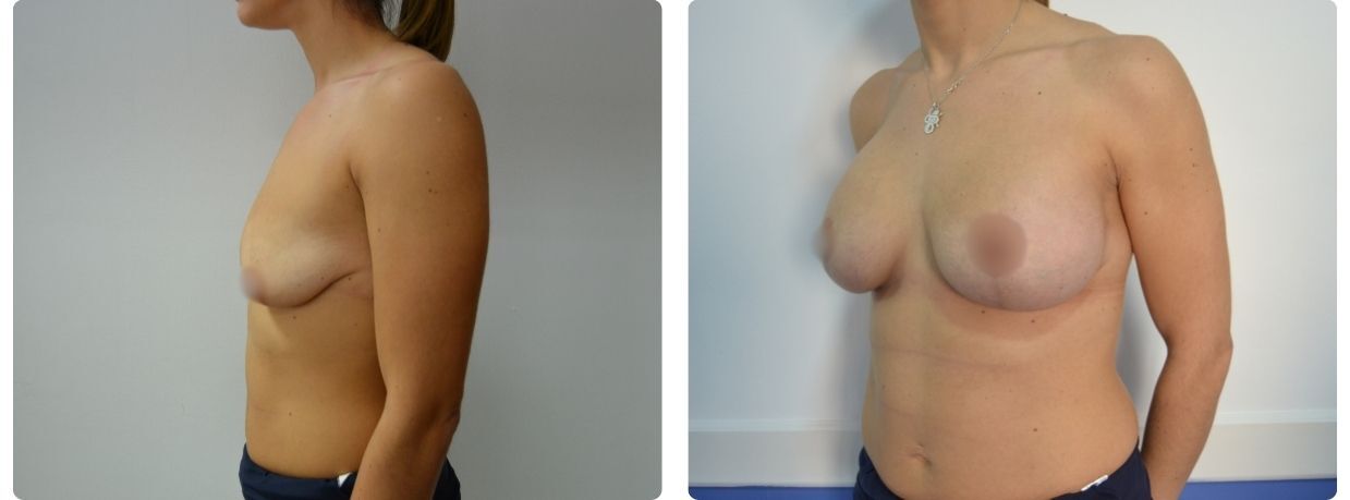 Resultados mastopexia implantes