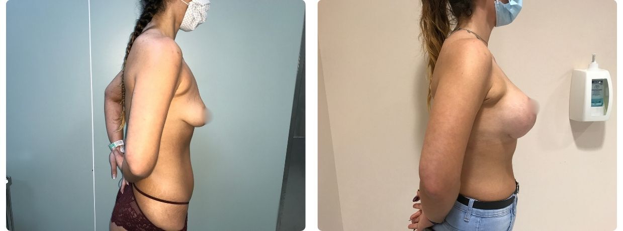 Resultados mastopexia implantes