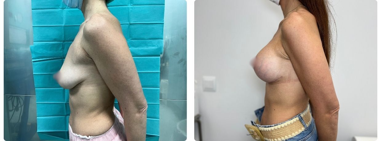 Resultados mastopexia implantes