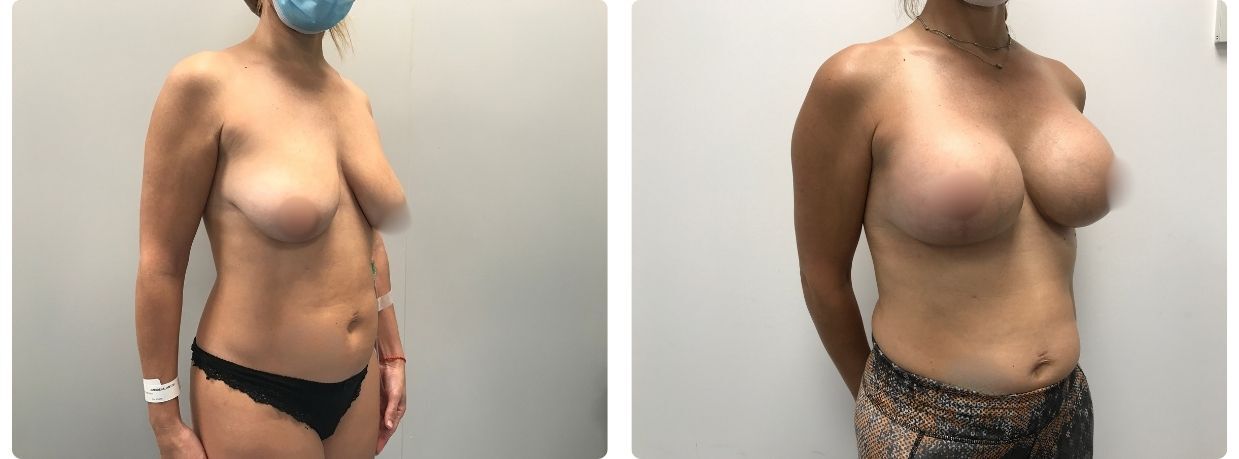 Resultados mastopexia implantes