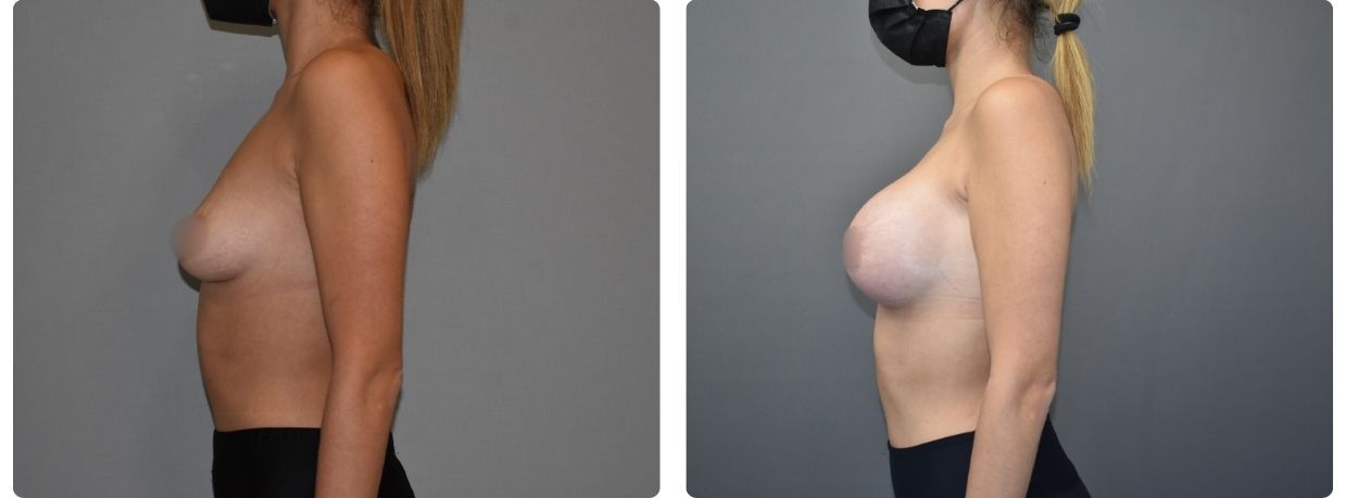 Resultados mastopexia implantes
