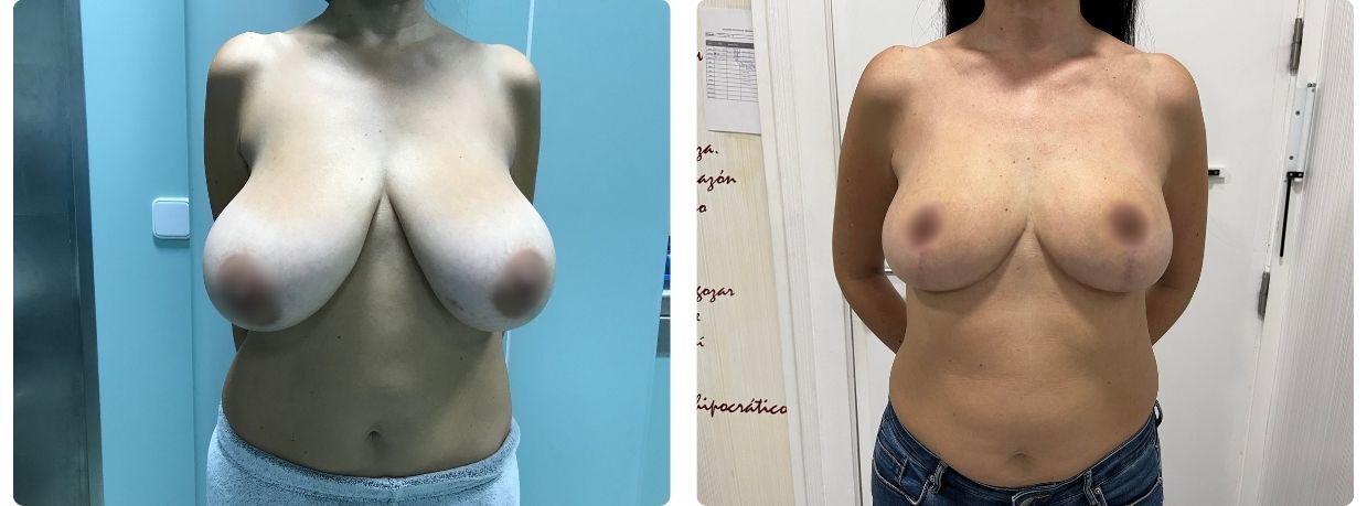 Resultados de mamoplastia de reducción