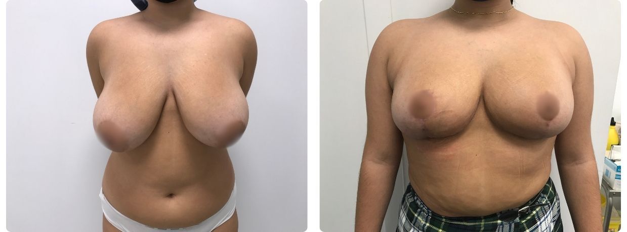 Resultados de mamoplastia de reducción