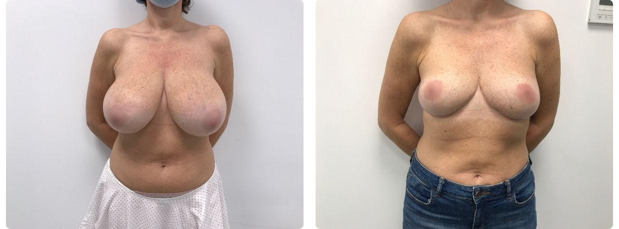 Resultados de mamoplastia de reducción