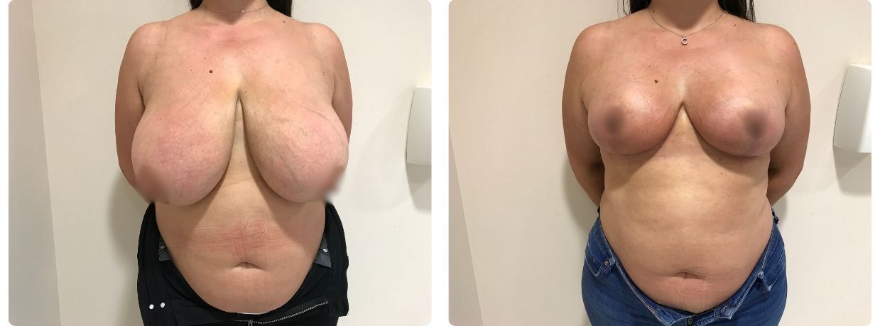 Resultados de mamoplastia de reducción
