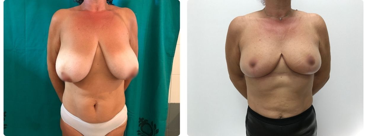 Resultados de mamoplastia de reducción