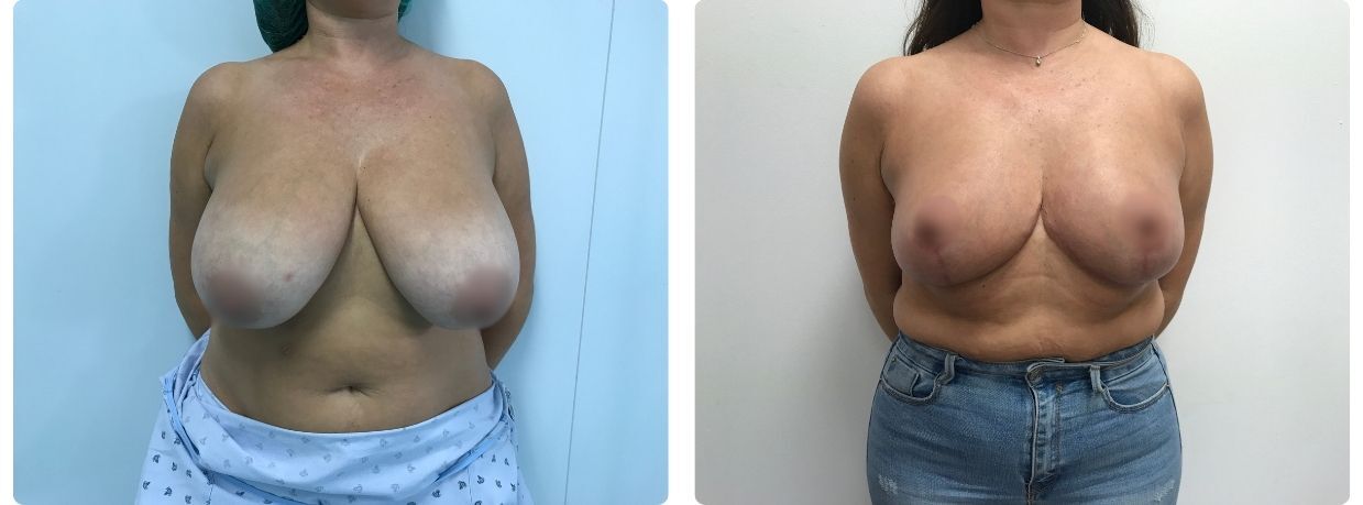 Resultados de mamoplastia de reducción