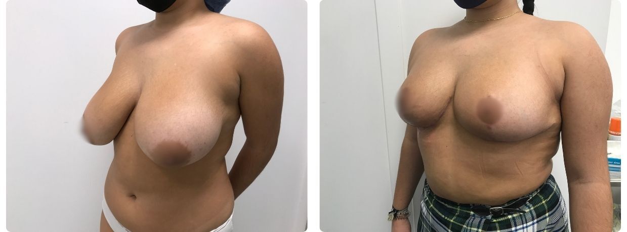 Resultados de mamoplastia reducción