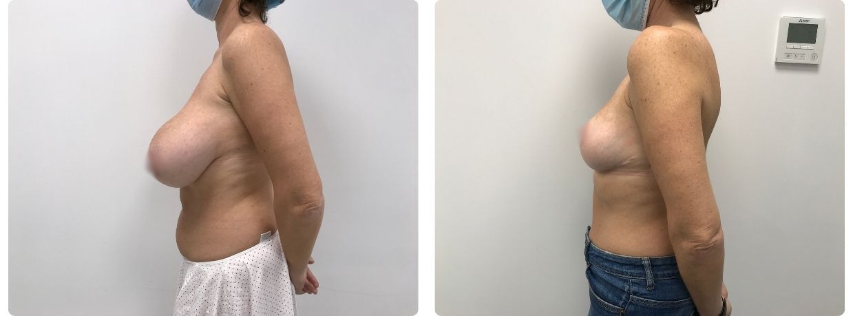 Resultados de mamoplastia reducción