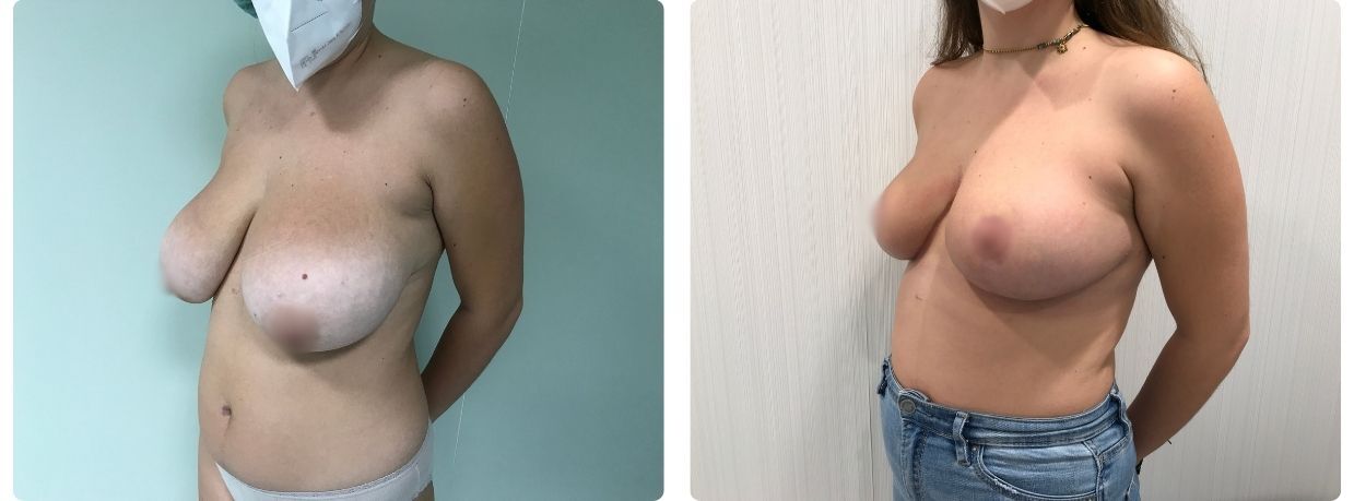 Resultados de mamoplastia reducción
