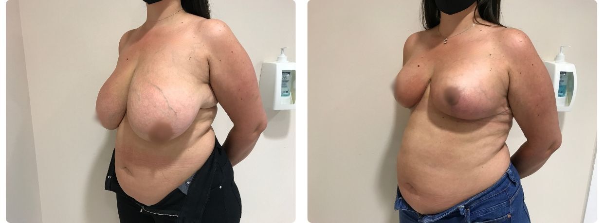 Resultados de mamoplastia reducción