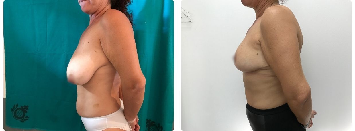 Resultados de mamoplastia reducción