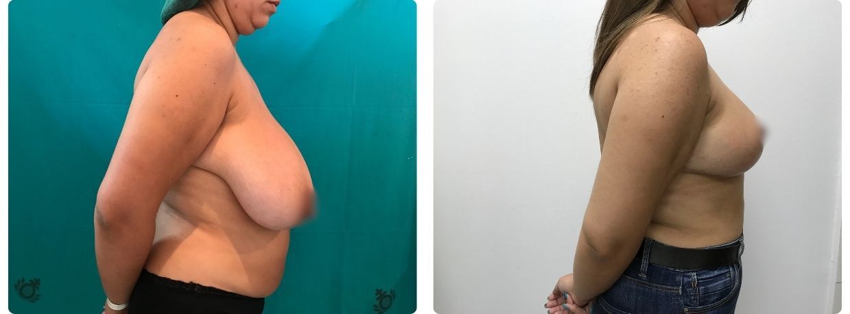 Resultados de mamoplastia reducción