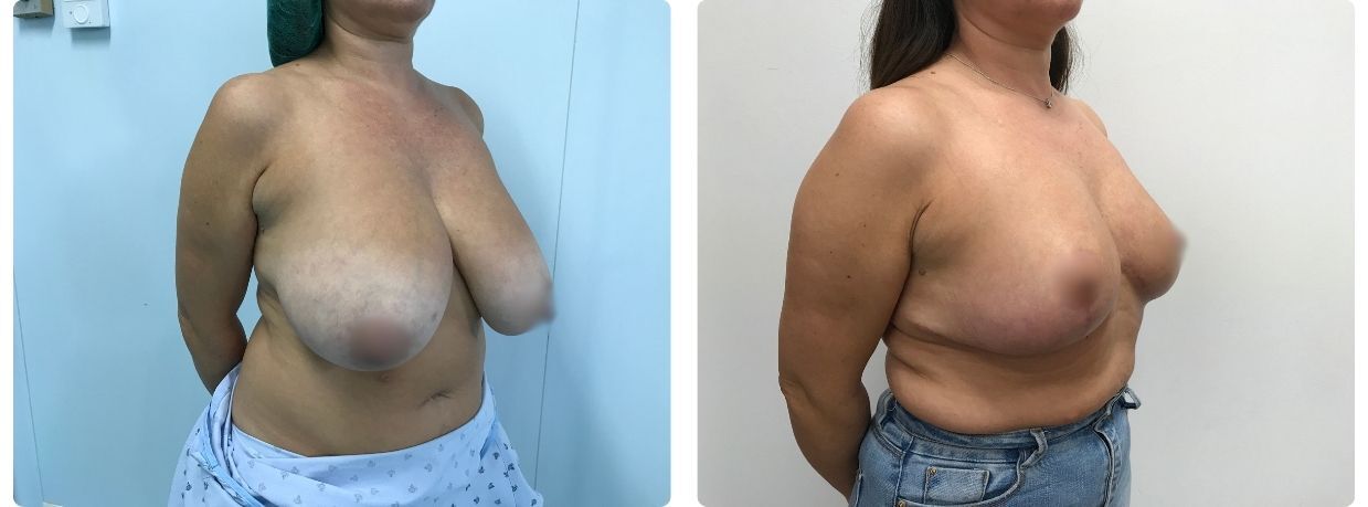 Resultados de mamoplastia reducción