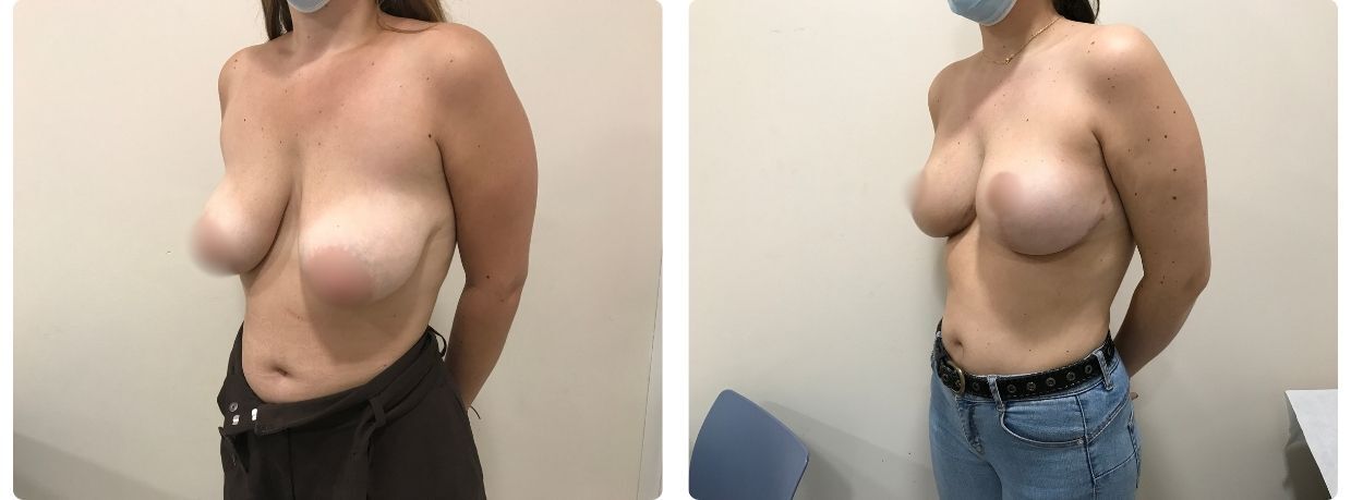 Resultados en mastopexia sin implantes
