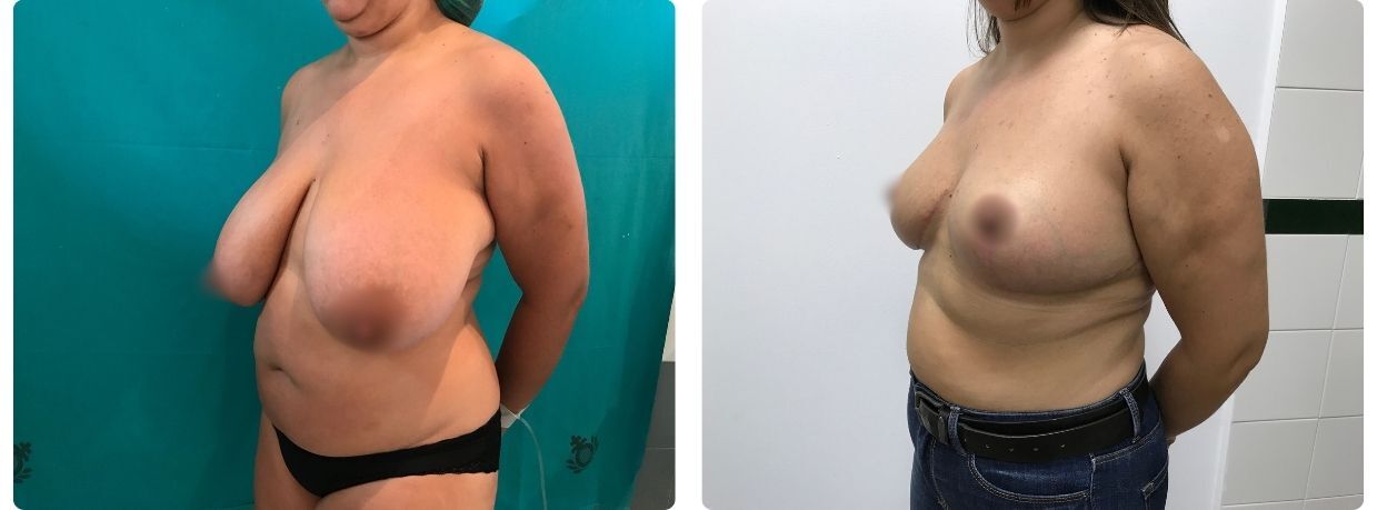 Resultados mamoplastia reducción