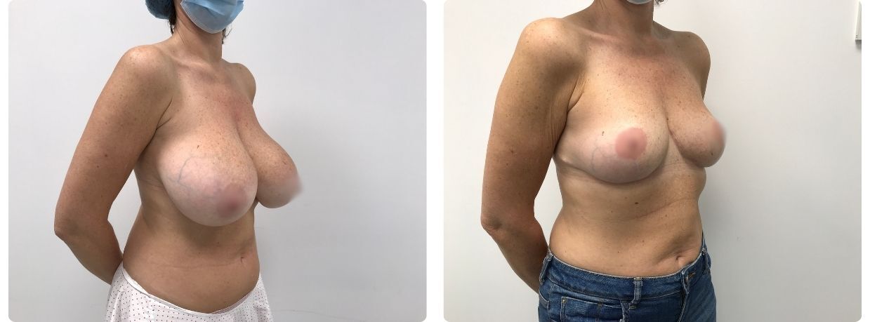 Resultados mamoplastia reducción