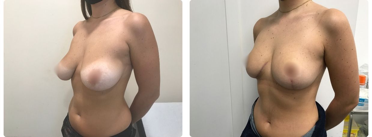 Resultados mastopexia implantes