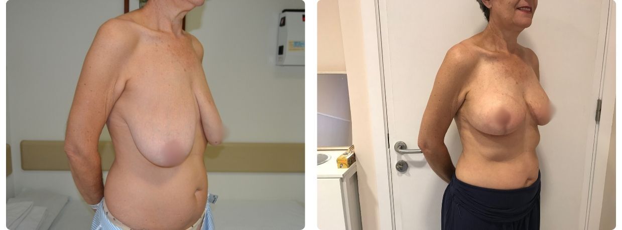 Resultados mastopexia implantes