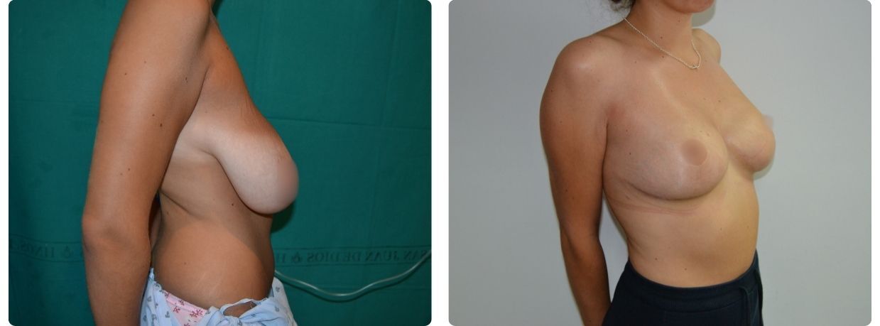 Resultados mastopexia implantes