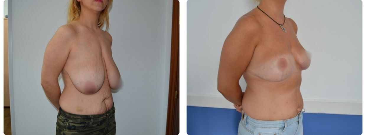 Resultados mastopexia implantes