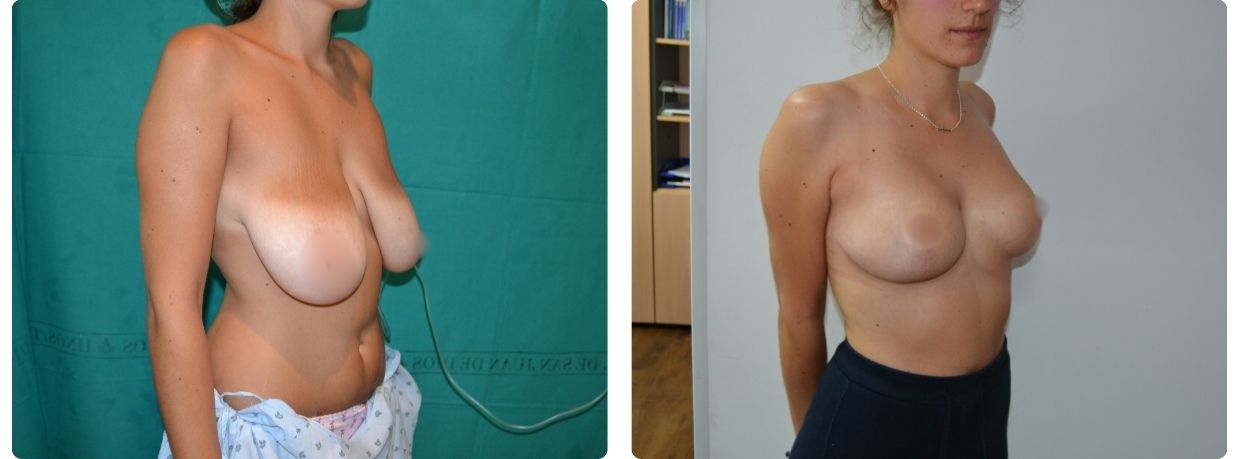 Resultados mastopexia sin implantes