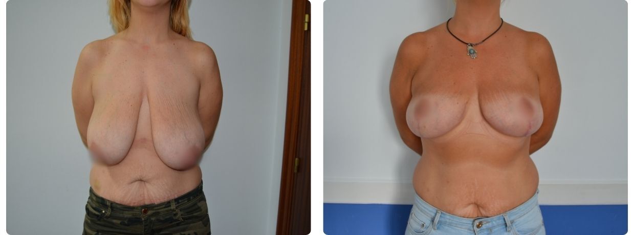 Resultados mastopexia sin implantes