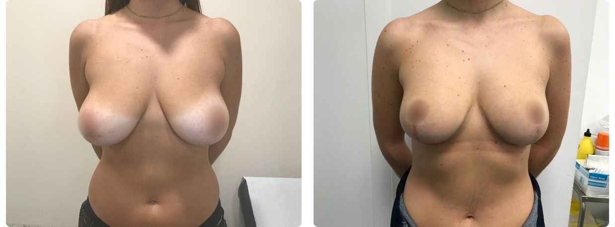 Resultados mastopexia sin implantes