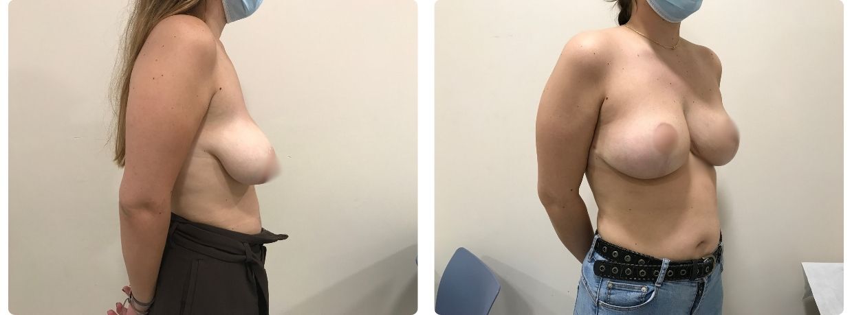 Resultados mastopexia sin implantes