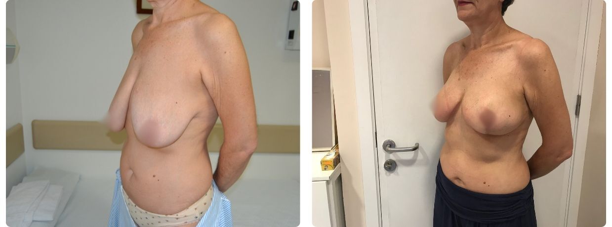 Resultados mastopexia sin implantes